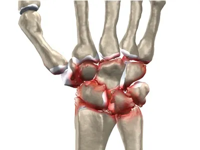 Wrist Pain: Fact You Should Know